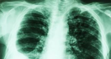 Drainage pleural et surveillance infirmière à domicile